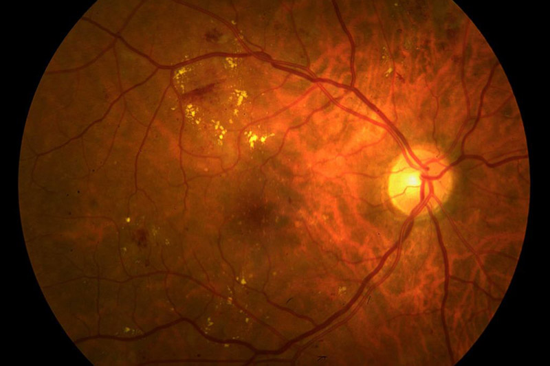 bien-chung-tieu-duong