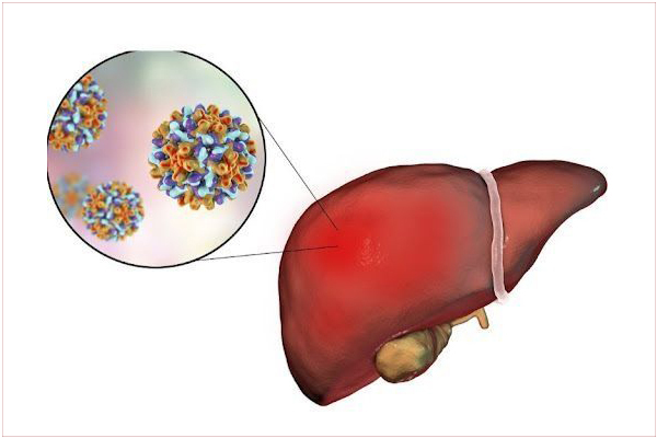 Viem-gan-A-la-benh-truyen-nhiem-do-virus-gay-ton-thuong-gan