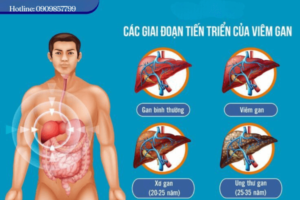 cac-giai-doan-viem-gan