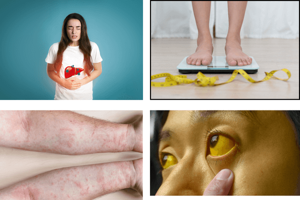 dau-hieu-nhan-biet-viem-gan-B