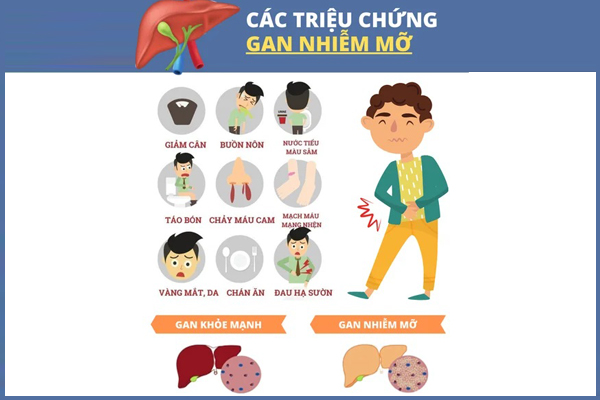 trieu-chung-benh-gan