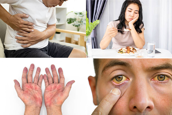 trieu-chung-bẹnh-gan