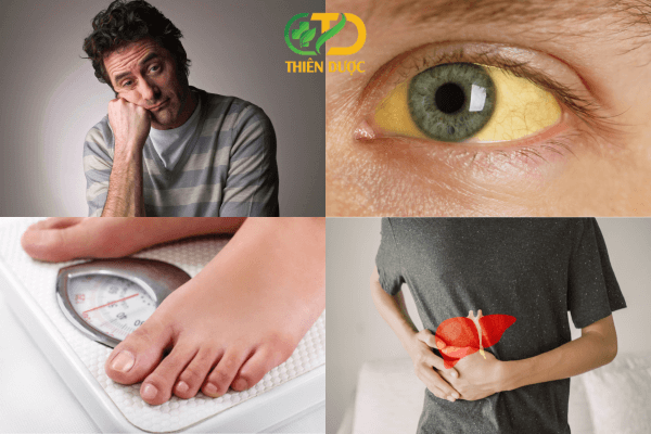 trieu-chung-cua-u-gan