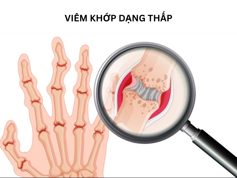 viem-khop-dang-thap