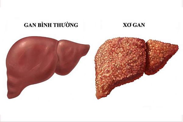 gan-xo-va-gan-binh-thuong