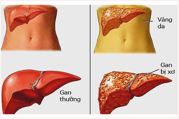 canh-bao-gan-suy-giam