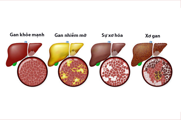 cac-giai-doan-dan-den-xo-gan