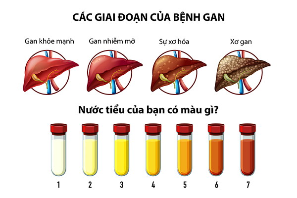 xet-nghiem-nuoc-tieu-phat-hien-dau-hieu-gan-nhiem-mo