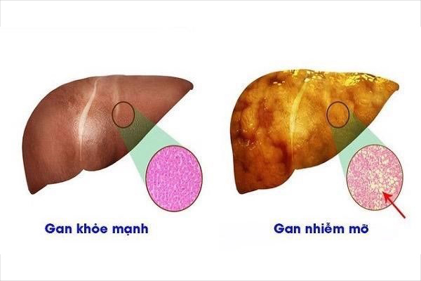 gan-nhiem-mo