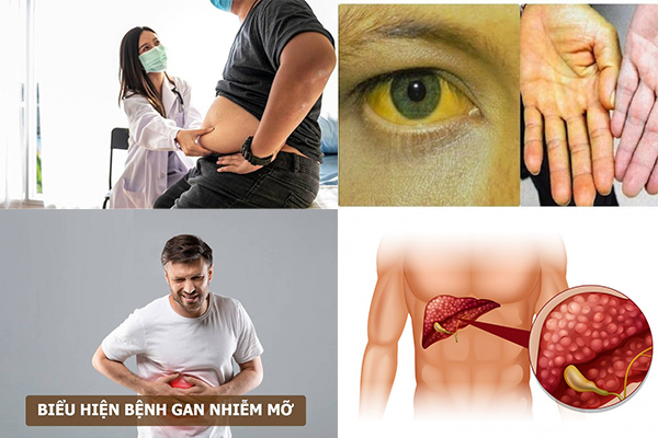 dau-hieu-gan-nhiem-mo