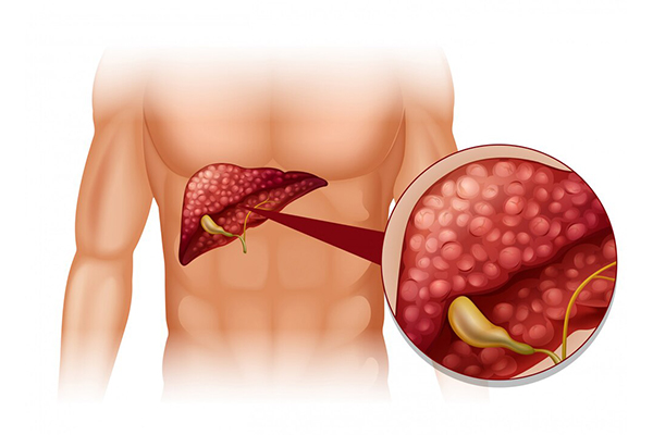 nhan-biet-trieu-chung-gan-nhiem-mo