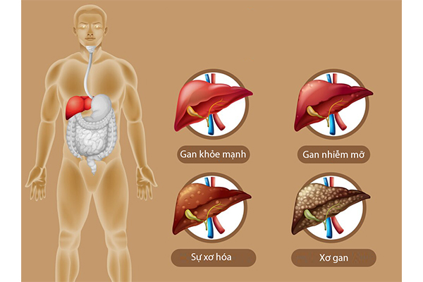 cac-cap-do-gan-nhiem-mo