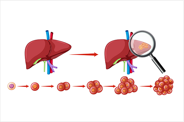 trieu-chung-gan-nhiem-mo