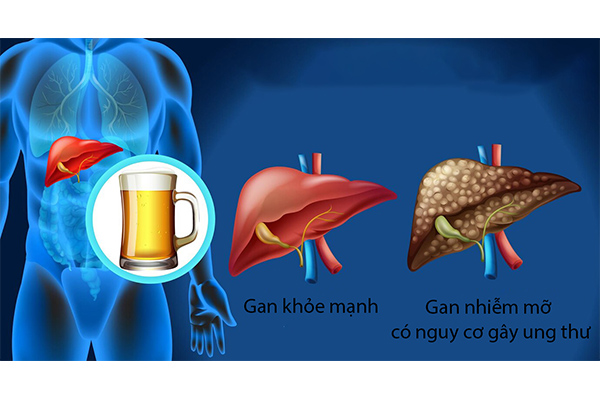 ruou-bia-gay-nguy-hiem-cho-nguoi-ung-thu-gan