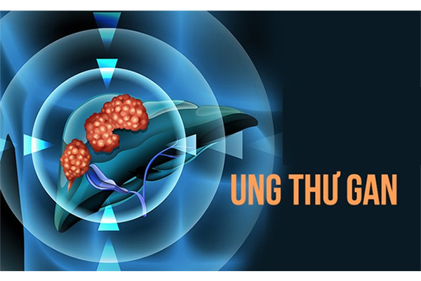 ung-thu-gan