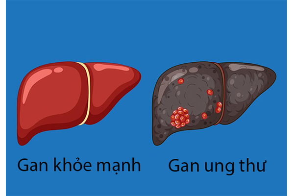 ung-thu-gan-co-thuc-su-nguy-hiem