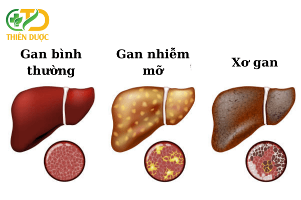 bien-chung-gan-nhiem-mo-dan-den-xo-gan-nghiem-trong