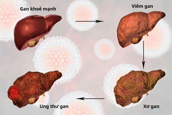 cac-muc-do-ton-thuong-gan