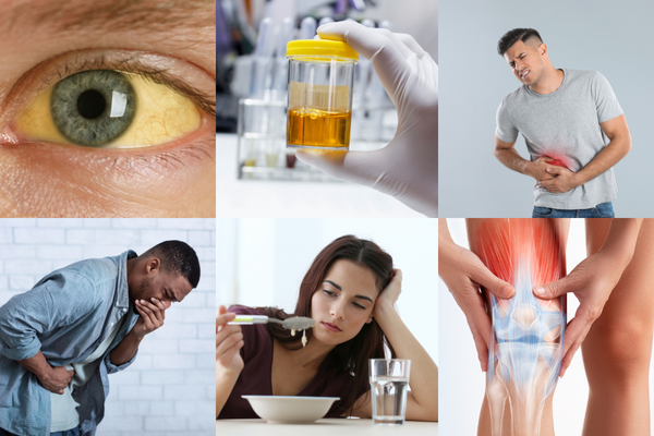 mot-so-trieu-chung-cua-benh-viem-gan