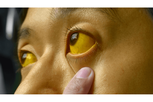 vang-da-la-dau-hieu-cua-nguoi-ung-thu-gan