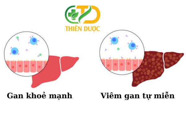 viem-gan-tu-mien-he-thong-mien-dich-tan-cong-co-the-gay-ton-thuong-gan